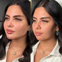 آموزش و تخفیفات ژل و بوتاکس درکلینیک
