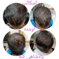 اسکالپ تخصصی در کلینیک پوست مو کاشت میکرو اسکالپ|خدمات آرایشگری و زیبایی|مشهد, شهید فرامرز عباسی|دیوار