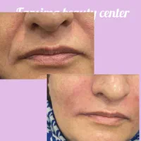 جشنواره تابستانه بوتاکس خال لاغری مزو‌ موفرسیما|خدمات آرایشگری و زیبایی|همدان, |دیوار