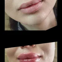تخفیف ویژه فیلر فقط۵۹۹بوتاکس فقط۶۹۹|خدمات آرایشگری و زیبایی|محمدیه-قزوین, |دیوار