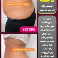لیزرموهای زائدولیزرلاغری وسم زدایی خال برداری|خدمات آرایشگری و زیبایی|کرمانشاه, |دیوار