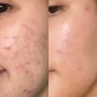 ضد جوش و آنتی آکنه گاتیو درمان جوش و جای جوش