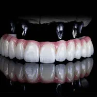دندانپزشکی کامپوزیت لمینت،بلیچینگ ،ایمپلنت