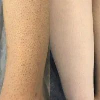 لیزر موهای زائد با ۴۰ درصد تخفیف،فول بادی فقط ۳۹۹