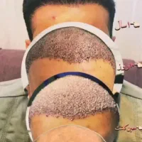 جشنواره ویژه بهاری کاشت مو وابرو