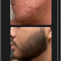 رویش ریش ۲۵ روزه تضمینی