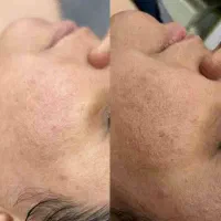 فشیال وپاکسازی پوست