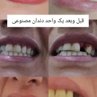 دندان مصنوعی