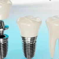 مرکز تخصصی ایمپلنت راز