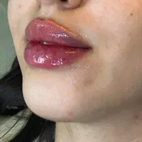 تخفیف خدمات ژل و بوتاکس در مطب