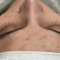 پلاژن تراپی