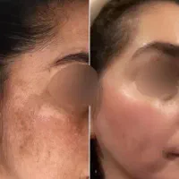 وایتکس پوست