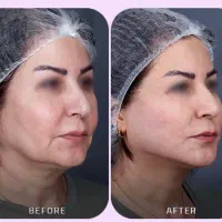 لیفت بانخ تخصصی /پی آر پی رایگان