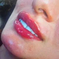 جشنواره‌ی تابستانه‌ی فیلر‌،بوتاکس و ژل لب/فیشیال
