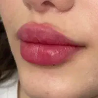 تخ*فیف ویژه خدمات زیبایی فیلر بوتاکس هایفوتراپی|خدمات آرایشگری و زیبایی|بوشهر, |دیوار