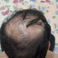 حجامت. فصد. زالو درمانی. حلزون تراپی. ماساژ|خدمات آرایشگری و زیبایی|کرج, استاندارد|دیوار