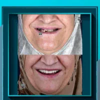 پیشنهادویژه عصبکشی دندان درپایتخت دندانپزشکی شیراز|خدمات زیبایی و سلامت|شیراز, ارم|دیوار