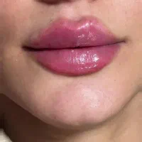 تزریق ژل ،فیلر بوتاکس مزو آنزیم خال برداری|خدمات آرایشگری و زیبایی|الیگودرز, |دیوار