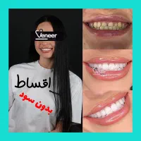 اقساط ایمپلنت ۵/۹۰۰ کامپوزیت لمینت ۱۰ م