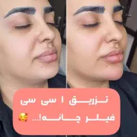 فیلرلب روسی ،گونه و زاویه،بوتاکس، فول فیس،زیرچشم|خدمات آرایشگری و زیبایی|شیراز, ستارخان|دیوار