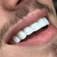 کامپوزیت دوفک در یک جلسه/ باضمانت و ماندگاری