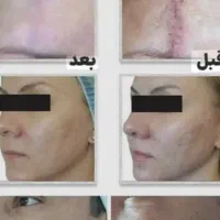 آراف فرکشنال منافذباز و جای اسکار