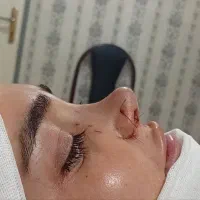 اف عمل بینی در اهواز