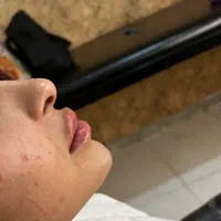 تخفیف جشنواره فیلر ژل لب و صورت یافت اباد فلاح|خدمات آرایشگری و زیبایی|تهران, تولید دارو|دیوار
