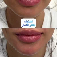 تزریق ژل لب فیلر بادی باسن بیکینی بوتاکس کانتور