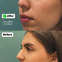 ژل ۸۰۰بوتاکس ۷۰۰ فول فیس ۵۸۰۰ لیفت صورت ۹۰۰