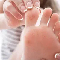 برداشتن زگیل و میخچه در یک جلسه