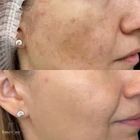 خال برداری رفع کک و مک با لیزر|خدمات آرایشگری و زیبایی|هشتگرد, مدرس|دیوار