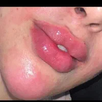 تزریق ژل و بوتاکس در کلینیک