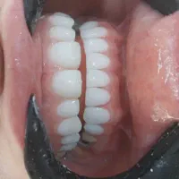 کامپوزیت دندان طرح لبخند جرمگیری بلیچینگ پالیش|خدمات آرایشگری و زیبایی|اهواز, نادری|دیوار