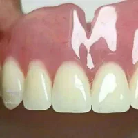 پروتز دندان دندانسازی تضمینی|آرایشی، بهداشتی، درمانی|صفادشت, |دیوار