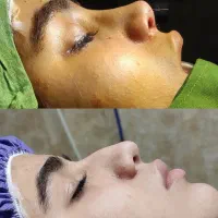 عمل زیبایی بینی