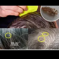 محلول شپش عالی و ازبین برنده