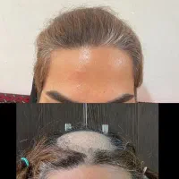 کاشت مو و ابرو با ضمانت نامه