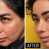 تزریق بوتاکس و لیفت چشم گربه ای  جدیدترین متد|خدمات آرایشگری و زیبایی|ری, دیلمان|دیوار