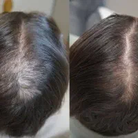 معجزه ریزش مو و پرپشتی مو