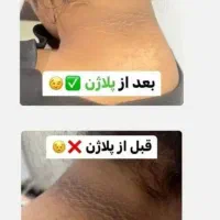 لیزر موهای زائد بدن|خدمات آرایشگری و زیبایی|شیراز, تحویلی|دیوار