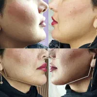 تزریق بوتاکس/انواع فیلر / لاغری|خدمات زیبایی و سلامت|مشهد, الهیه|دیوار
