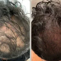 قطع ریزش مو و رشد دوباره مو