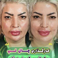 جراحی عمل لیفت صورت شقیقه ابرو پلک غبغب سانترال