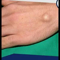 رفع غده های زیرپوستی|خدمات آرایشگری و زیبایی|خمینی‌شهر, |دیوار