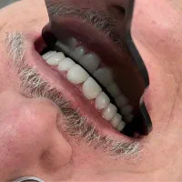 کامپوزیت دندان با برندهای معتبر جهانی