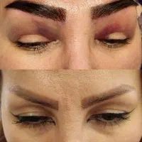 جشنواره یلدایی کاشت مو ، ابرو و مزوتراپی و prp|خدمات آرایشگری و زیبایی|زنجان, |دیوار