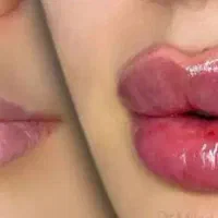 نیازمند مدل فیلر لب توسط پزشک