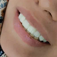 آموزش کامپوزیت دندان ،بیلیچینگ ،لمیمنت روکش دندان|خدمات آرایشگری و زیبایی|کرج, چهارصد دستگاه|دیوار