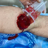 فصد پیشانی حجامت زالو درمانی|خدمات آرایشگری و زیبایی|ارومیه, |دیوار